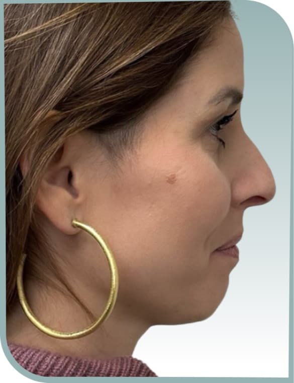 Chin profile, Before photo (result 1 of 10)
