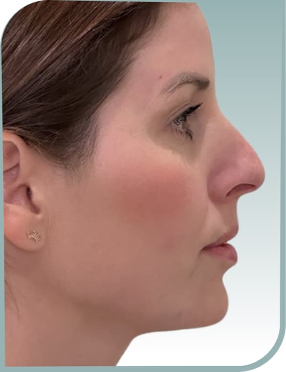 Chin profile, After photo (result 1 of 10)