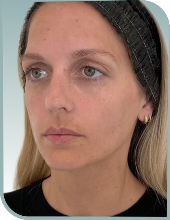 Lip volume — Before photo (result 10 of 10)