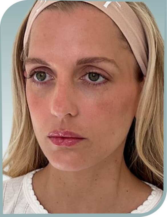 Lip volume — After photo (result 10 of 10)