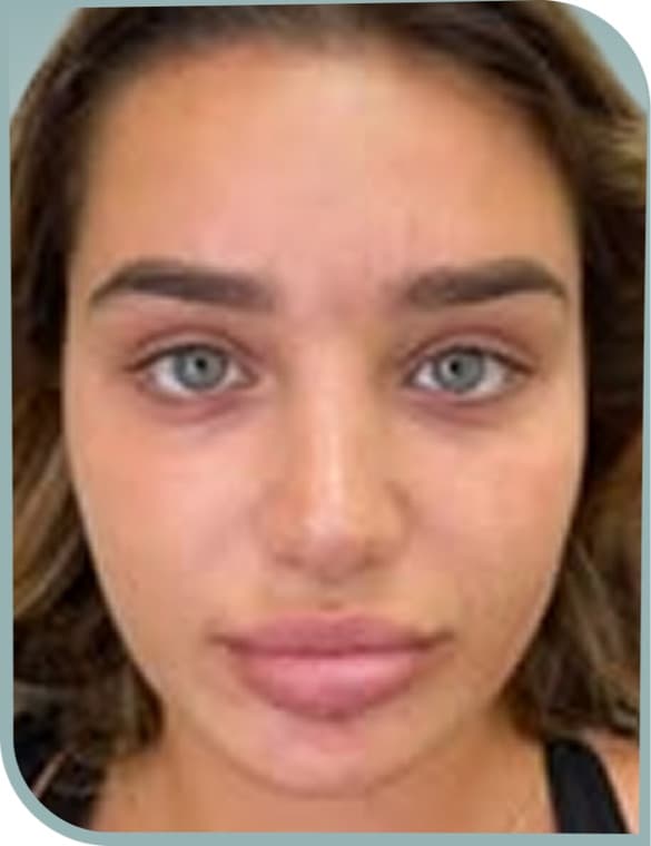 Lip shape, Before photo (result 2 of 10)