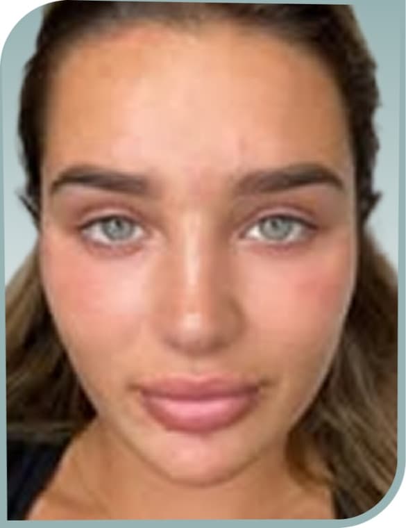 Lip shape, After photo (result 2 of 10)