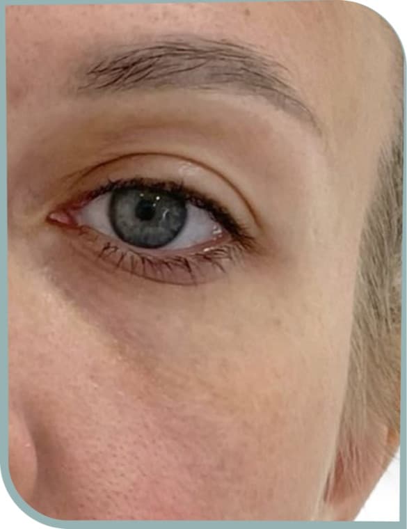 Tear trough, Before photo (result 4 of 10)