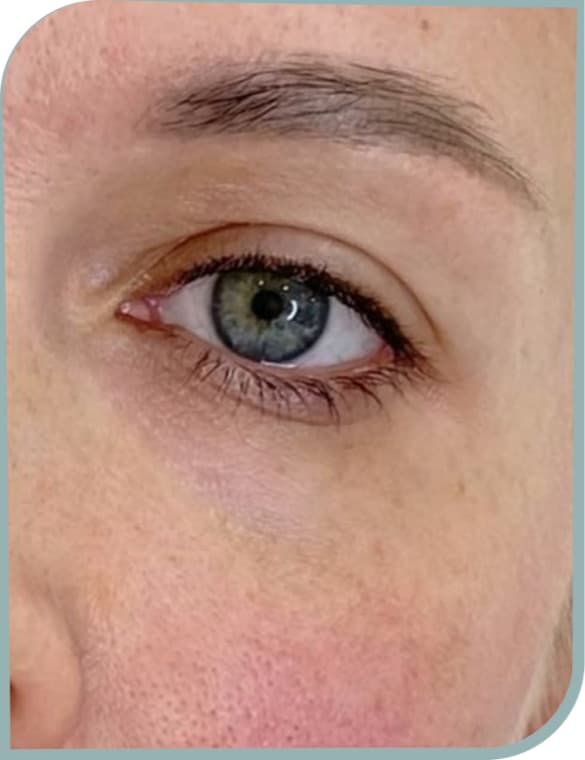 Tear trough, After photo (result 4 of 10)