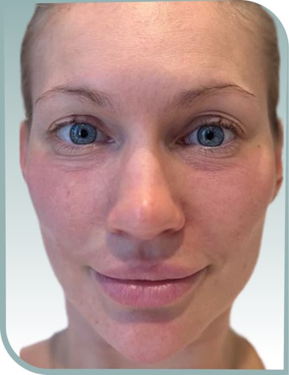 Lip volume, Before photo (result 5 of 10)