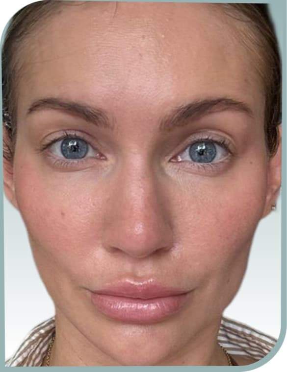 Lip volume, After photo (result 5 of 10)