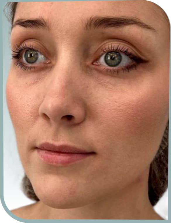 Lip enhancement — Before photo (result 6 of 10)