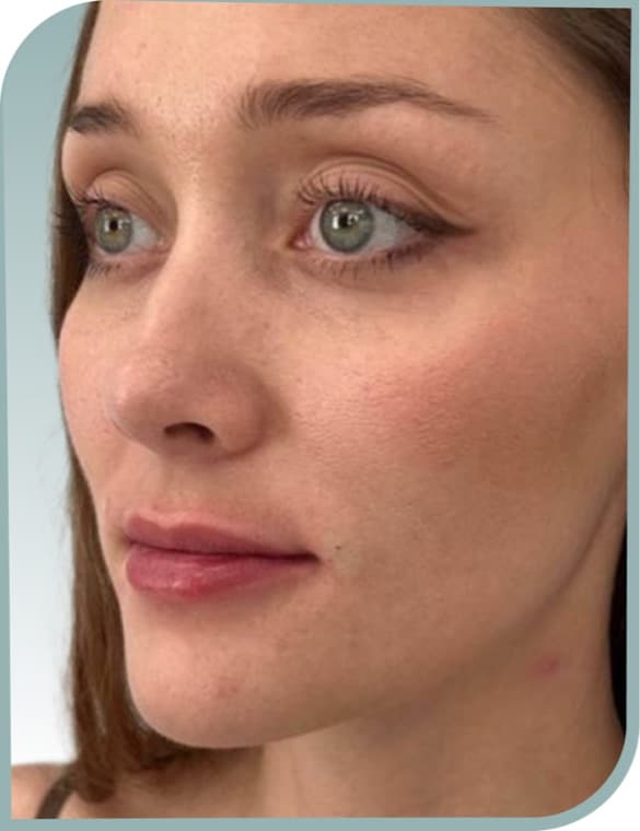 Lip enhancement, After photo (result 6 of 10)