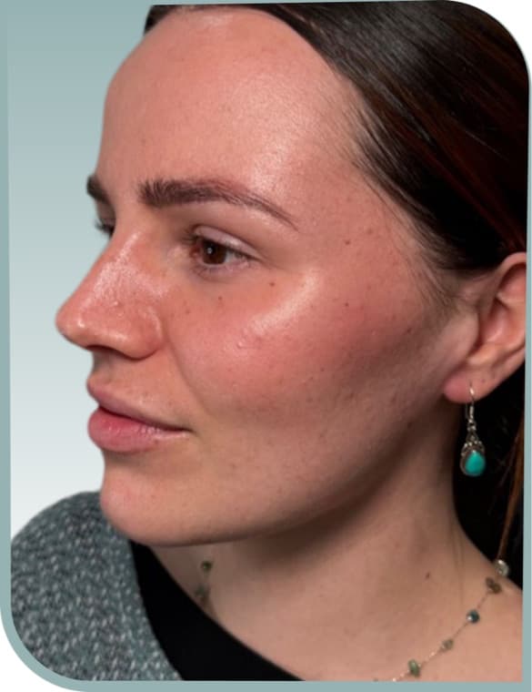 Lip definition, Before photo (result 7 of 10)