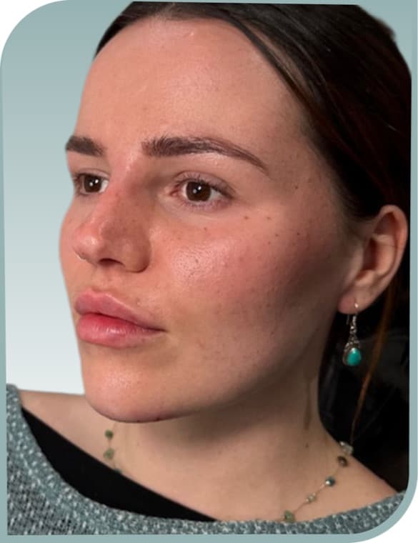 Lip definition, After photo (result 7 of 10)