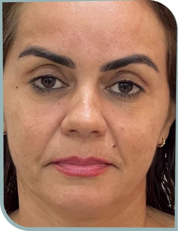 Smile line softening, Before photo (result 8 of 10)