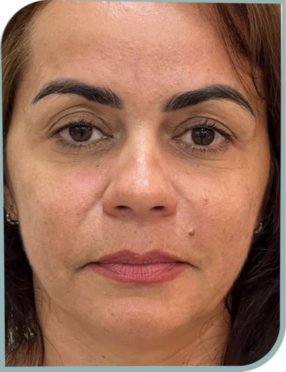 Smile line softening — After photo (result 8 of 10)