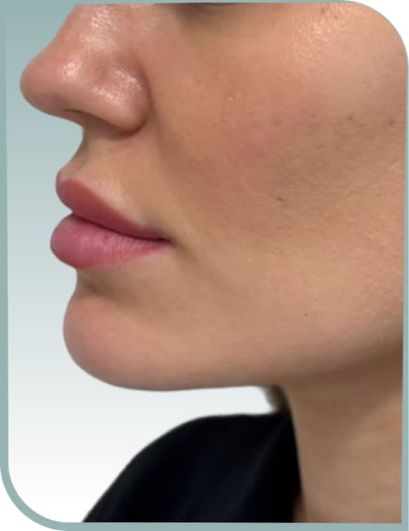 Lip profile, After photo (result 9 of 10)