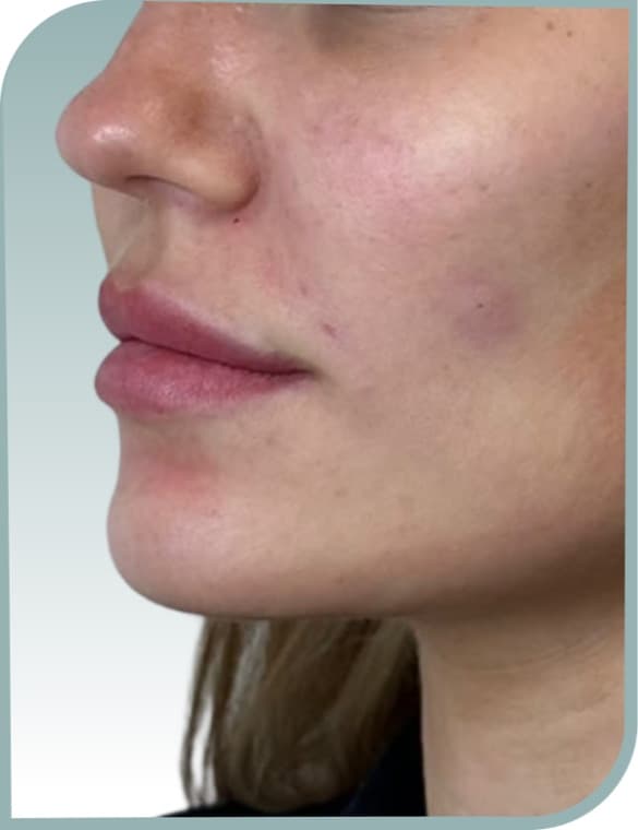 Lip profile — Before photo (result 9 of 10)