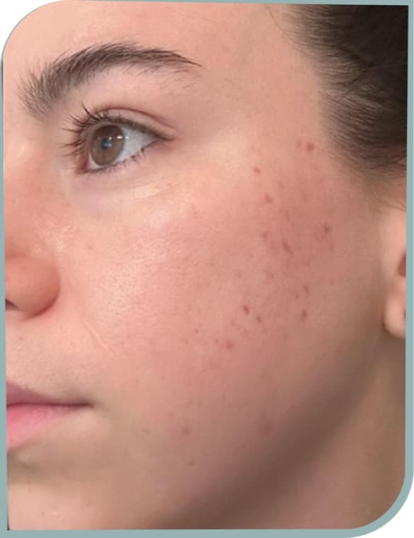 Post-acne marks, Before photo (result 5 of 6)