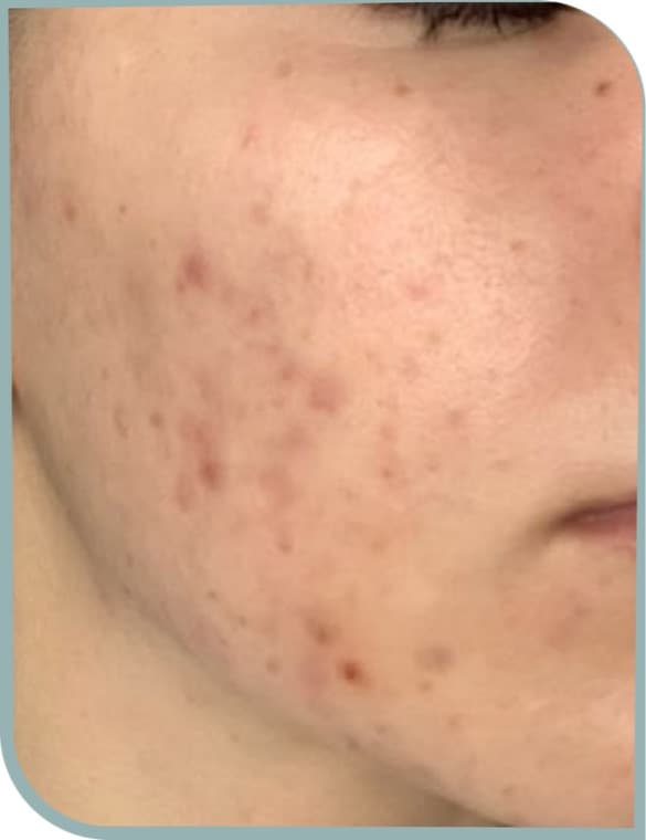 Acne scarring and texture, Before photo (result 4 of 6)