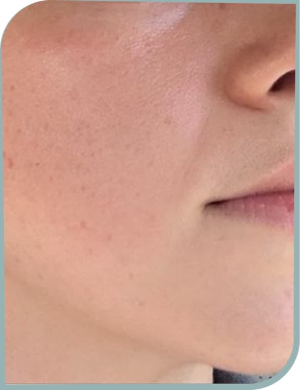 Cheek redness, After photo (result 2 of 6)