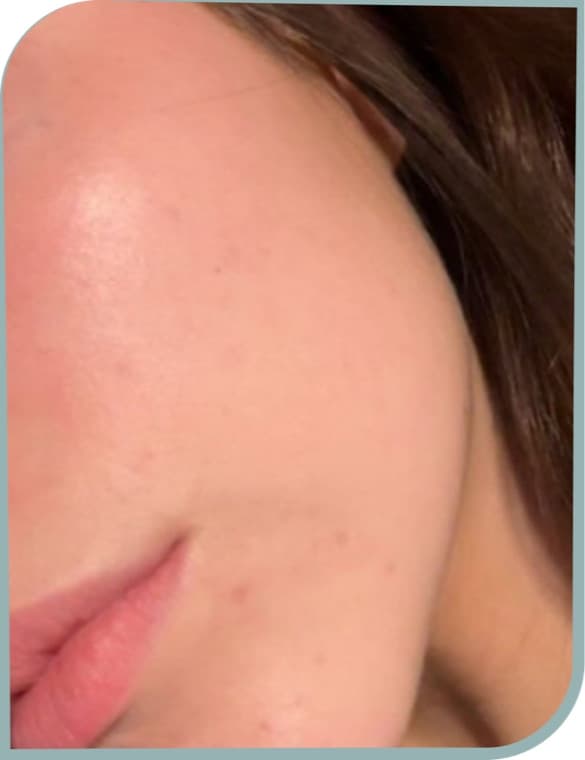Cheek and chin acne, After photo (result 3 of 6)