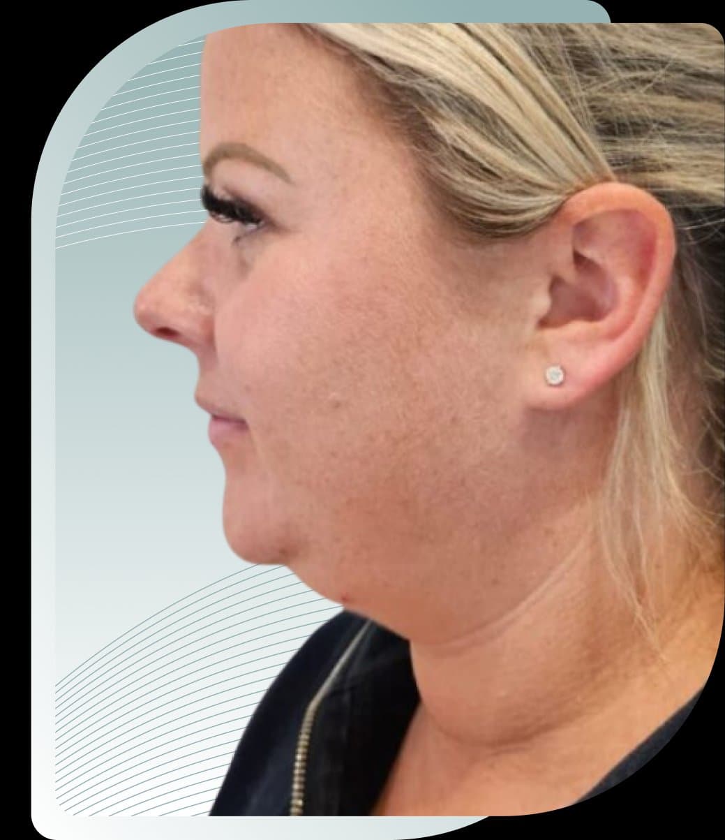 Fat dissolving treatment at Carisma Aesthetics Malta
