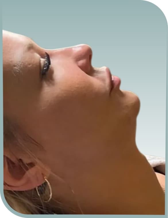 Under-chin fullness, After photo (result 1 of 10)