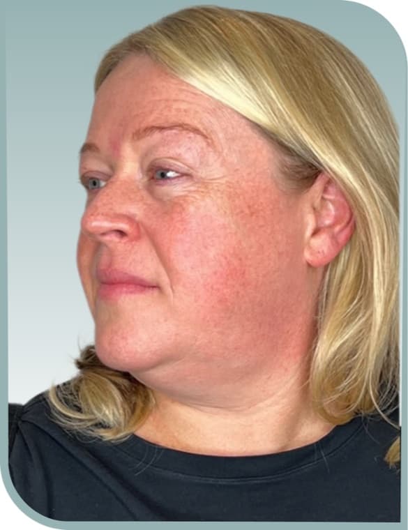 Jowl and neck, Before photo (result 10 of 10)