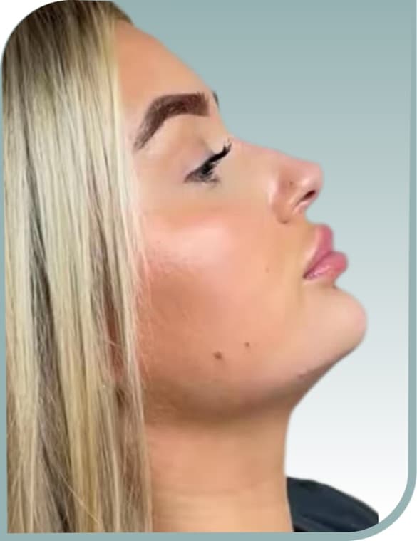 Double chin, After photo (result 2 of 10)