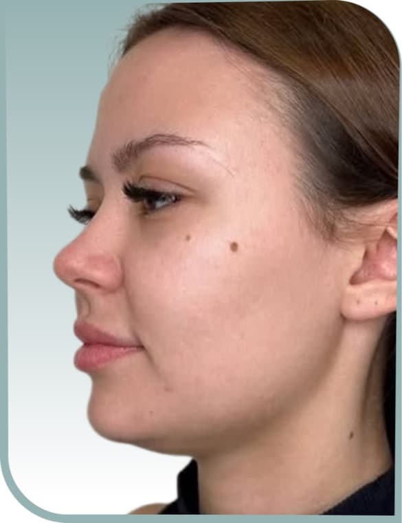 Jawline contour, Before photo (result 4 of 10)