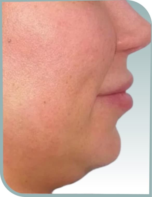 Chin and jaw, Before photo (result 5 of 10)