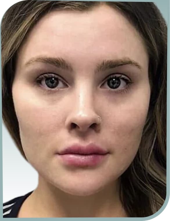 Cheek fullness, After photo (result 6 of 10)