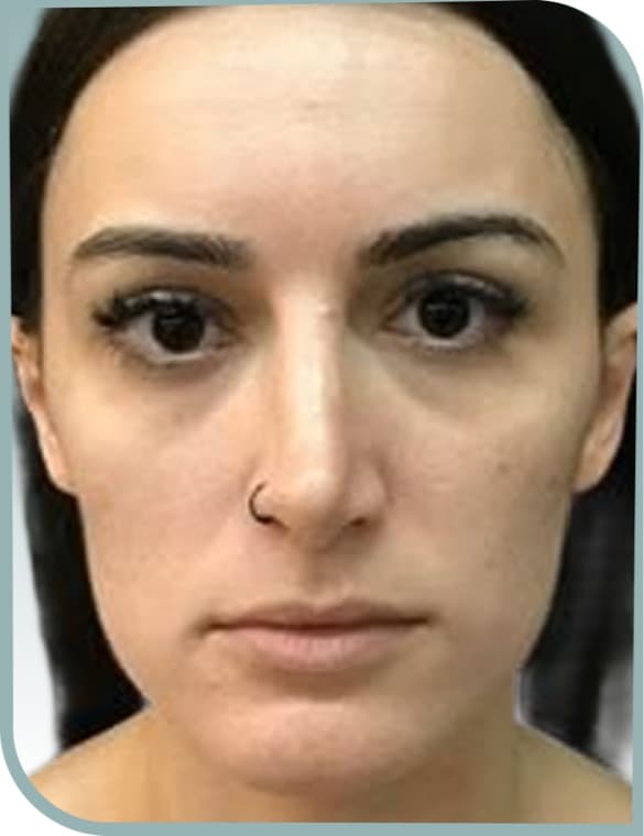 Lower face slimming, Before photo (result 7 of 10)