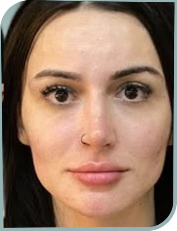 Lower face slimming, After photo (result 7 of 10)