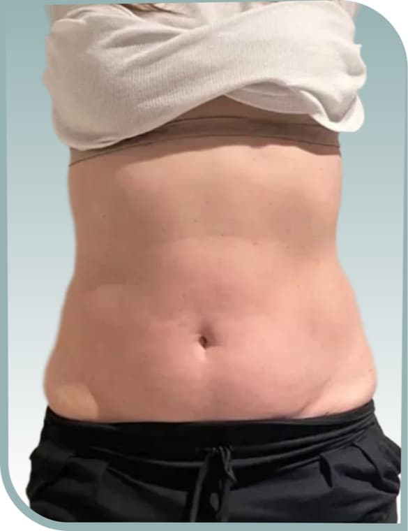 Lower belly fat, Before photo (result 1 of 10)