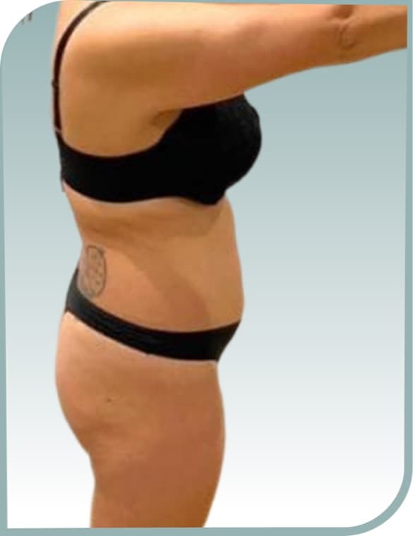 Love handles, After photo (result 9 of 10)
