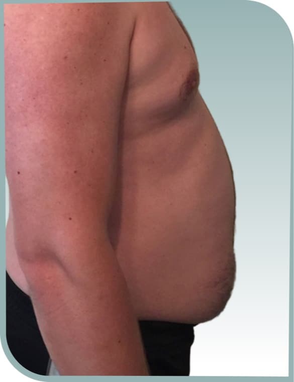 Belly fat, After photo (result 8 of 10)