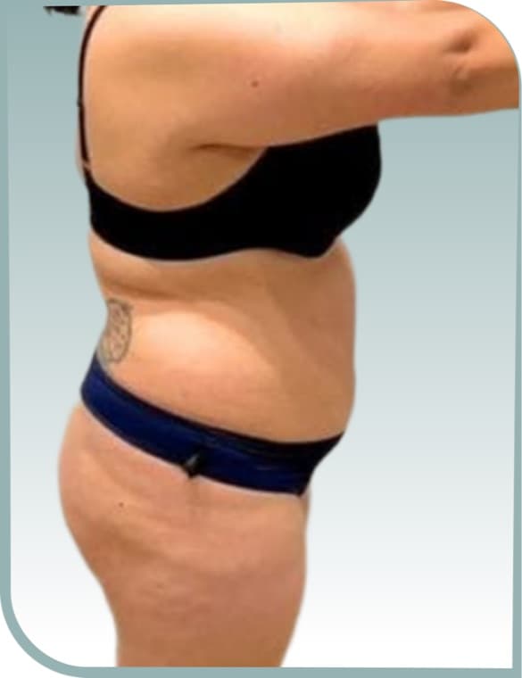 Love handles, Before photo (result 9 of 10)