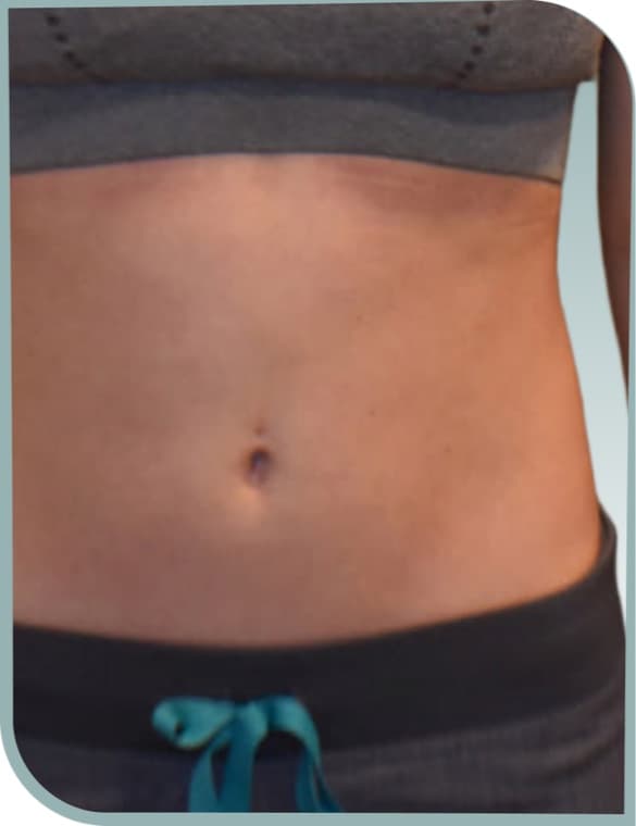 Lower belly fat, After photo (result 1 of 10)