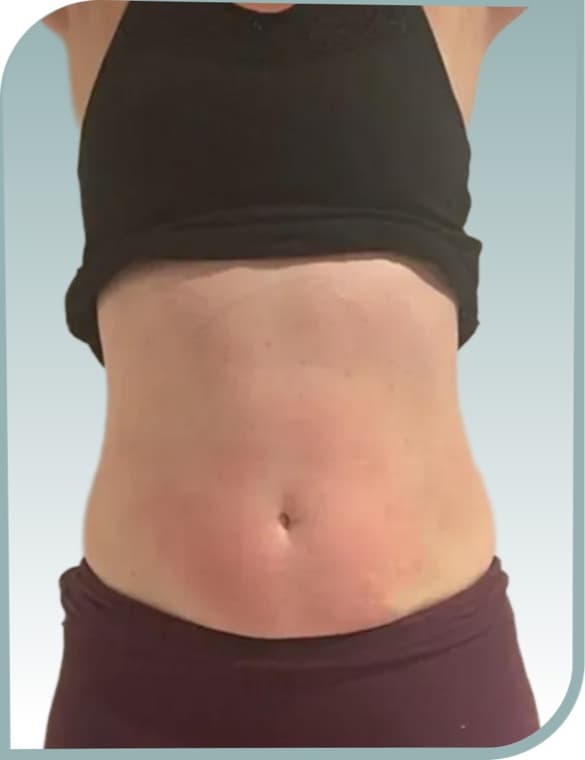 Stomach fat, Before photo (result 10 of 10)