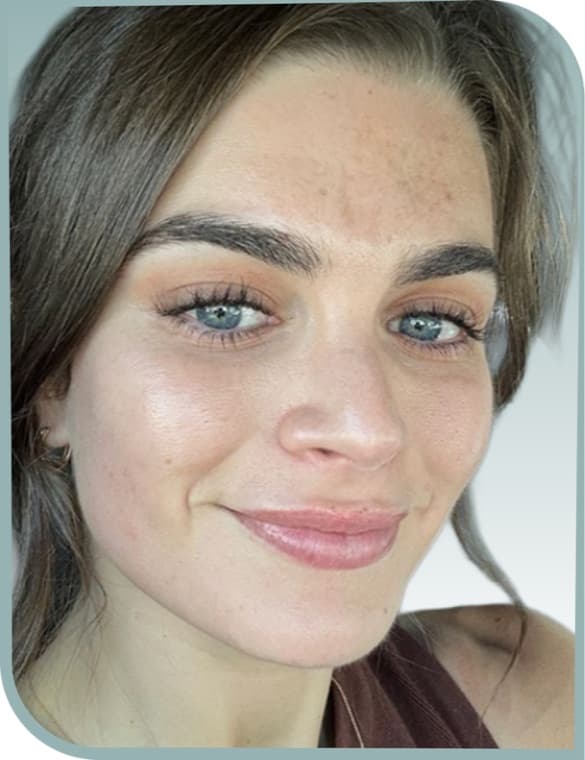 Brighter, clearer skin, Before photo (result 1 of 10)
