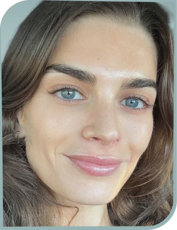 Brighter, clearer skin, After photo (result 1 of 10)