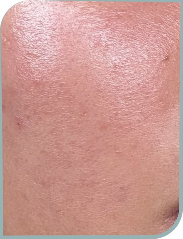 Smoother cheek texture, After photo (result 2 of 10)