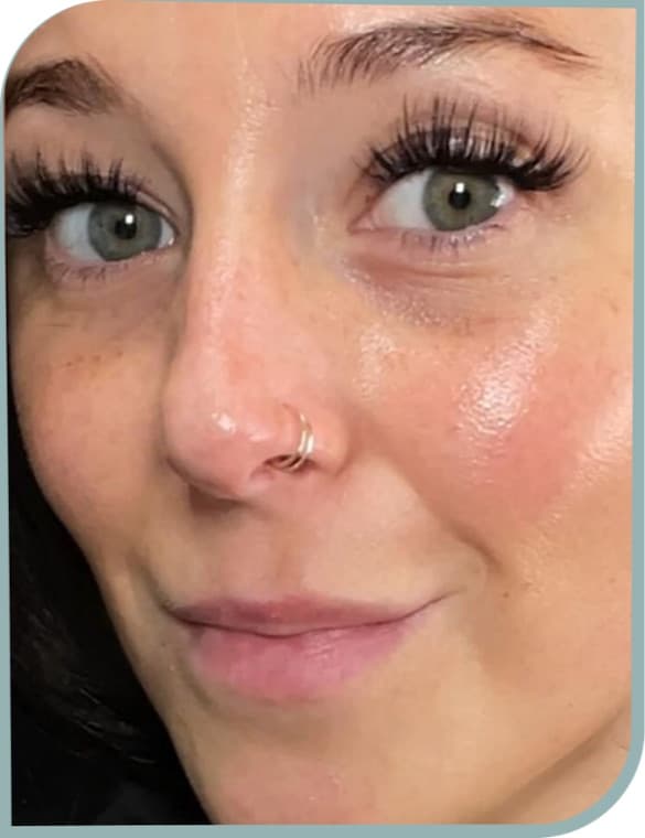 Under eye brightening, After photo (result 8 of 10)