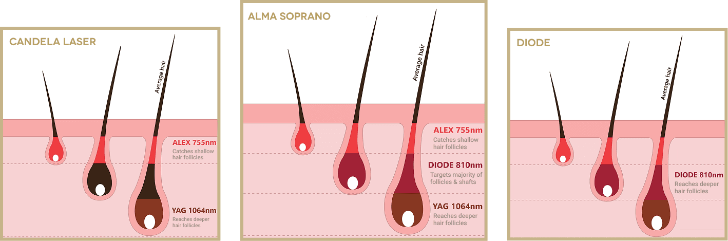 Alma Soprano's triple-wavelength technology targets every depth of follicle, for the first time in Malta.