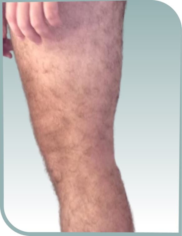 Lower leg hair, Before photo (result 1 of 10)