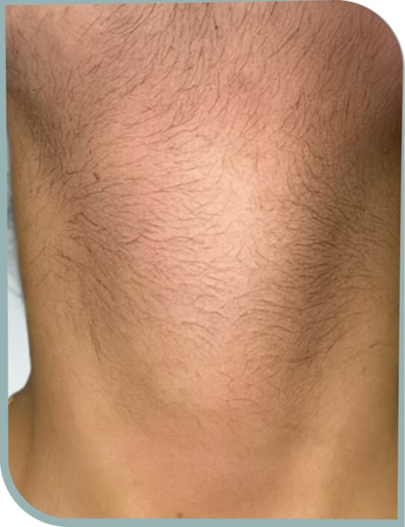 Underarm hair, Before photo (result 9 of 10)