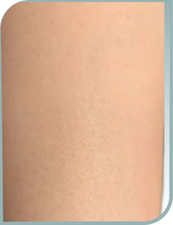 Thigh hair, After photo (result 2 of 10)