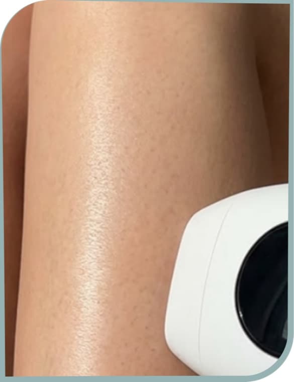 Leg hair reduction, After photo (result 3 of 10)