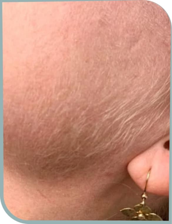 Jawline hair, Before photo (result 6 of 10)