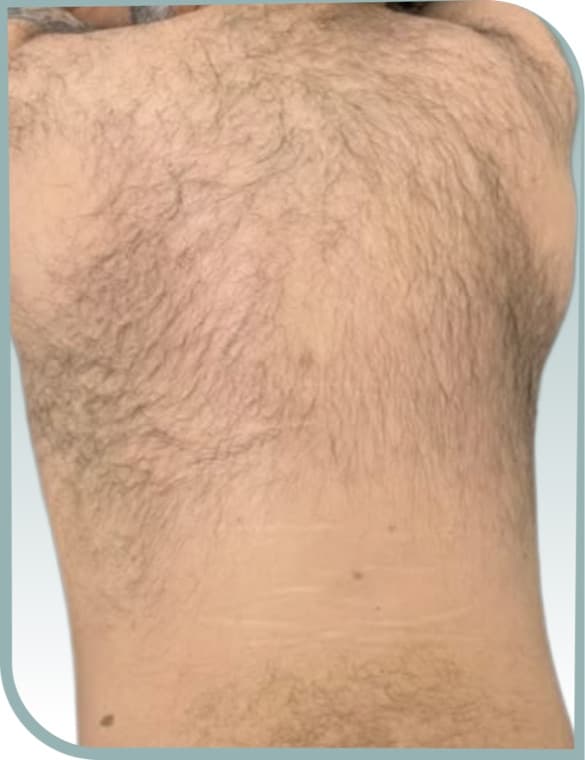 Back hair removal, Before photo (result 4 of 10)