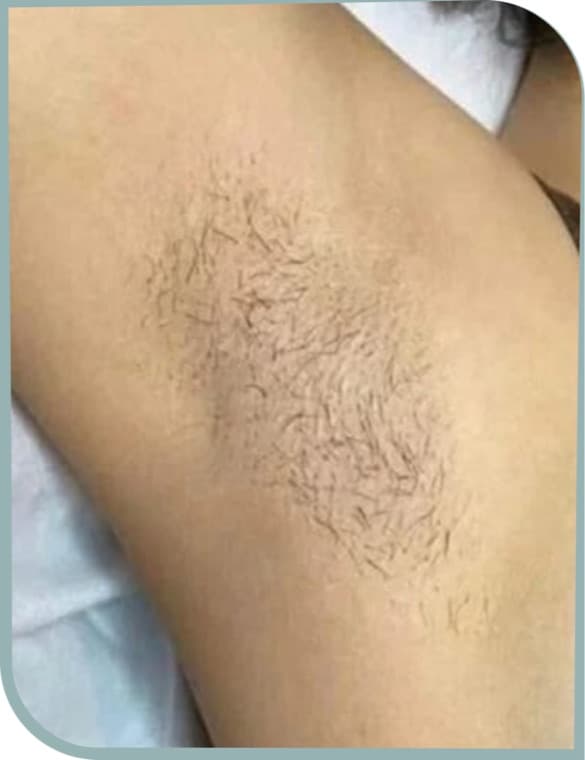 Neck hair reduction, Before photo (result 7 of 10)