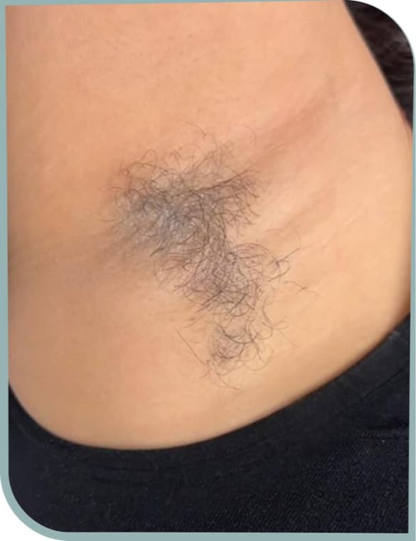 Underarm hair, Before photo (result 10 of 10)